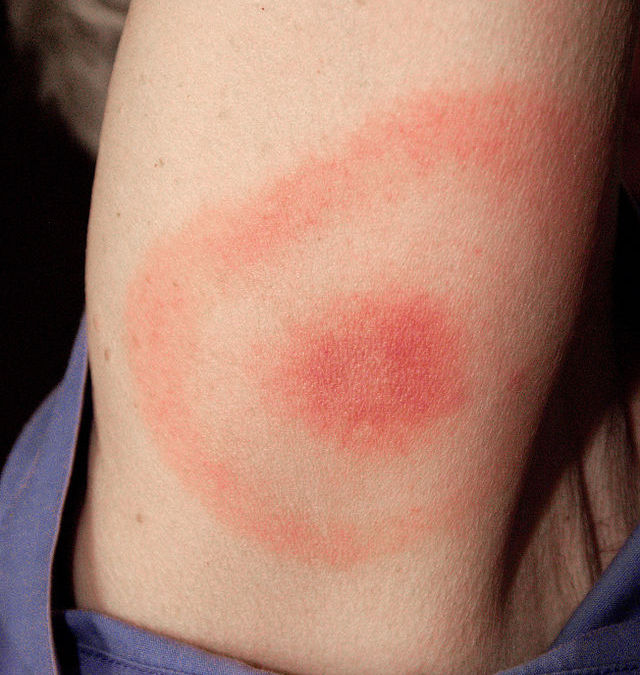 Not Everyone With Lyme Disease Develops A Rash